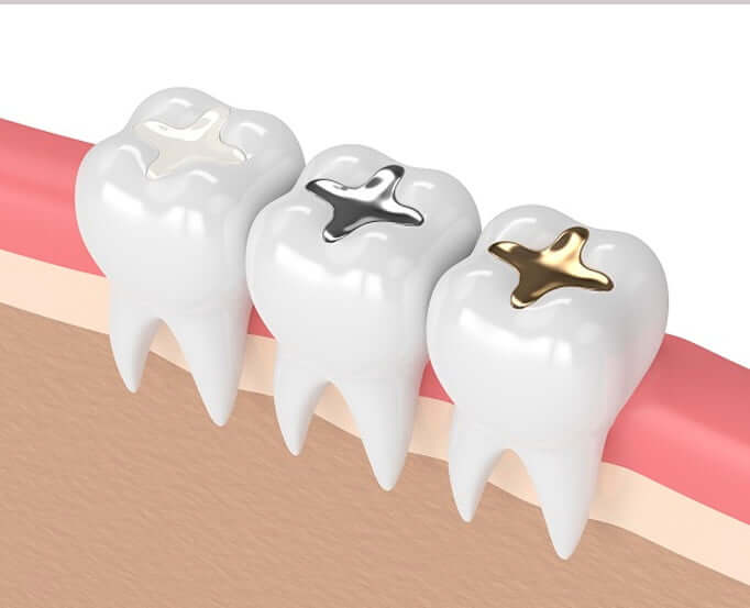 illustration of teeth with amalgam fillings