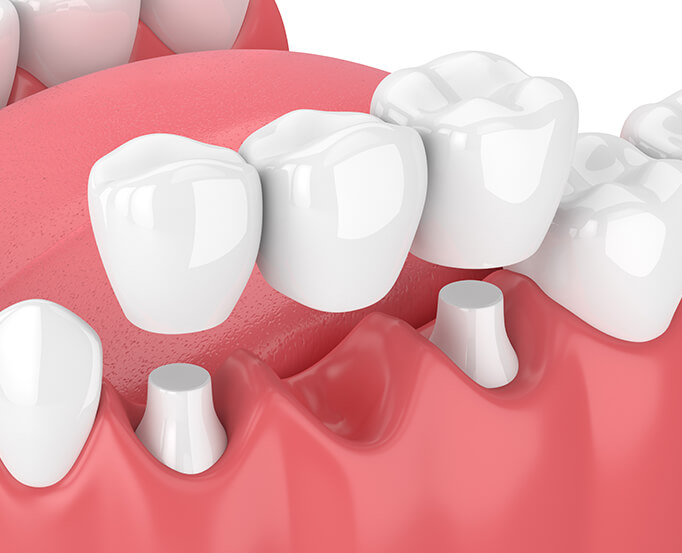 illustration of a dental bridge