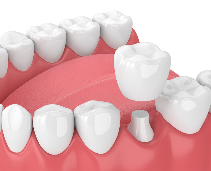 Model of a dental crown being placed